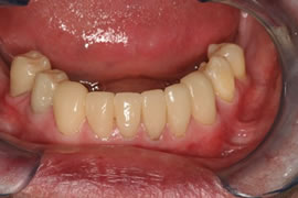 CEREC AC OMNICAM ПРОСТОЕ СКАНИРОВАНИЕ БЕЗ АНТИБЛИКОВОГО СПРЕЯ 29.jpg