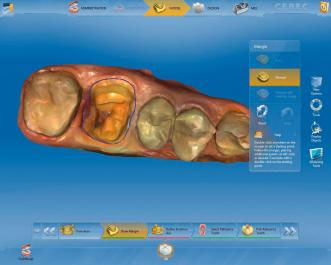 CEREC AC OMNICAM ПРОСТОЕ СКАНИРОВАНИЕ БЕЗ АНТИБЛИКОВОГО СПРЕЯ 12.jpg