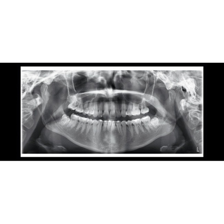 Planmeca ProOne - универсальный цифровой ортопантомограф