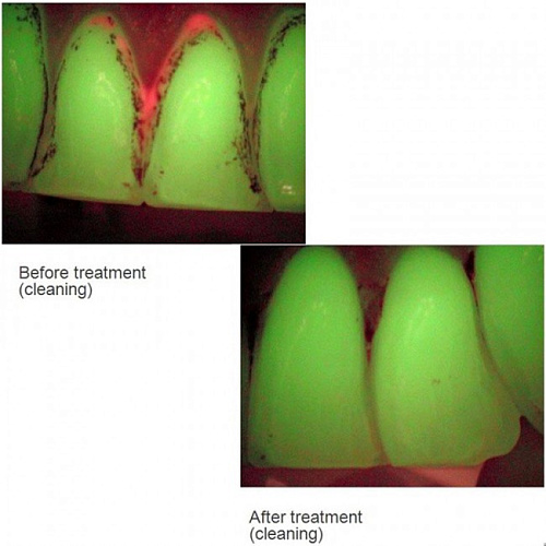 Air Techniques Spectra - оптический детектор кариеса 
