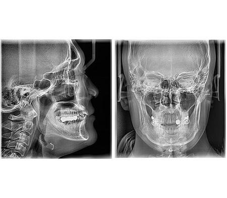 Vatech PaX-i 3D SC 10x8.5 - томограф с цефалостатом